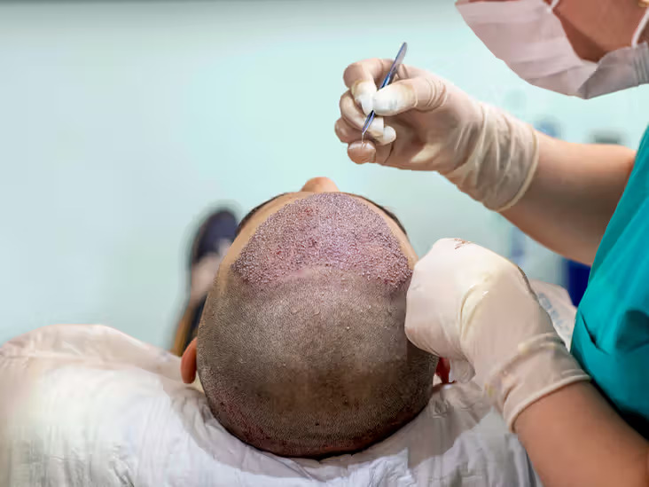 Hair-transplant-surgery