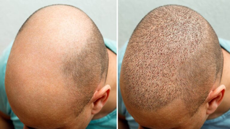 hair transplant