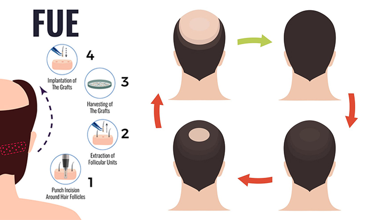 FUE Hair Transplant