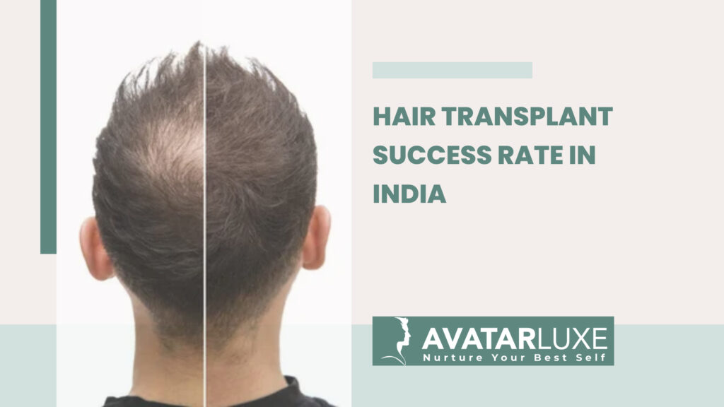 Success Rate of Hair Transplant